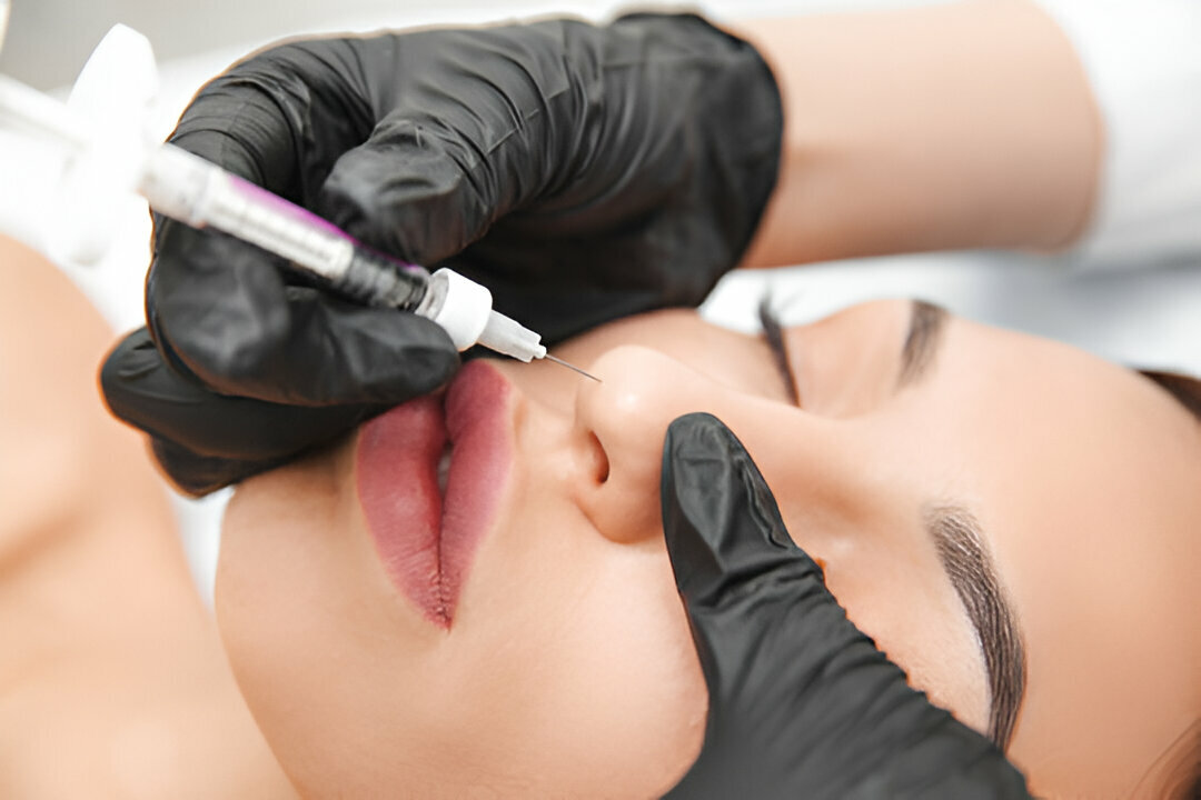 nose filler in london